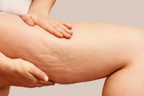 Image of woman showing leg with cellulite Gerrards Cross