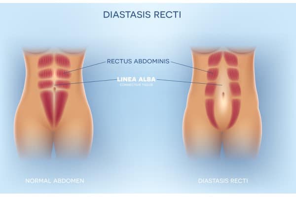 What Non-Surgical Options Are Available for Diastasis Recti Gerrards Cross?