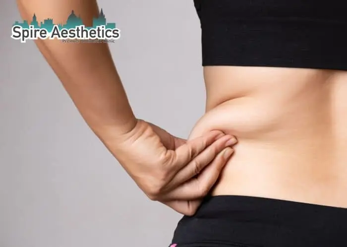 Image of woman pinching fat on their hips Gerrards Cross. Fat Freezing treatment