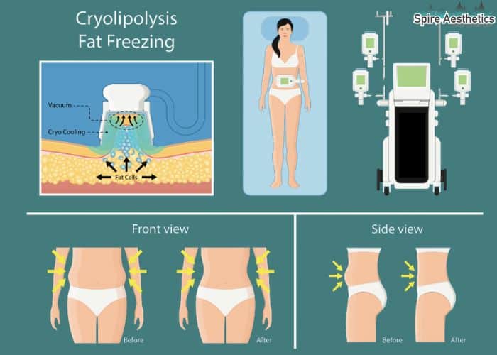 Image of diet and fat freezing combined for best results for Spire Aesthetics Gerrards Cross
