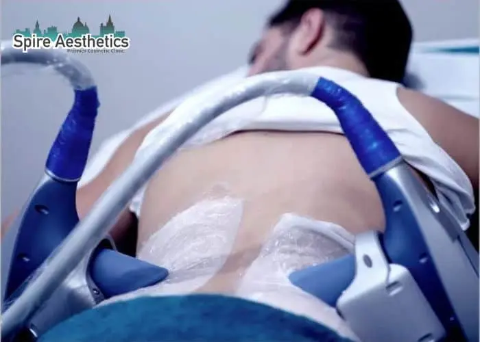 Man having fat freezing treatment done on love handles before a competitions Gerrards Cross to create a sculpted look.