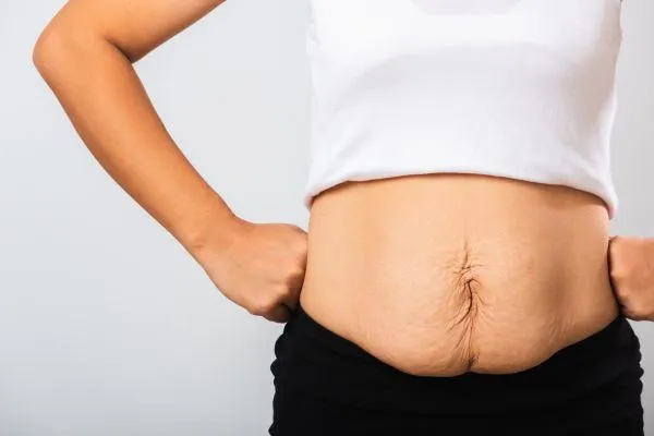 Image of a woman's stomach after weight loss with sagging skin following a gastric band Gerrards Cross