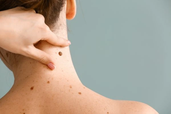 skin blemish removal Gerrards Cross treatment