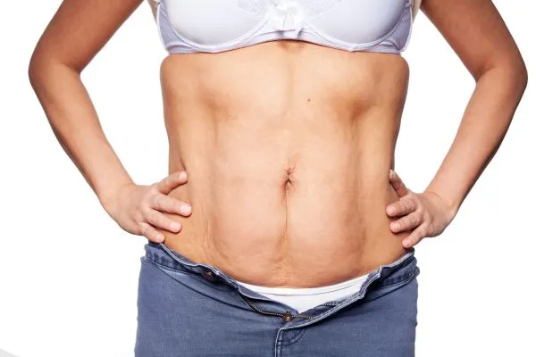 sagging skin on woman's stomach after weight loss injections Gerrards Cross