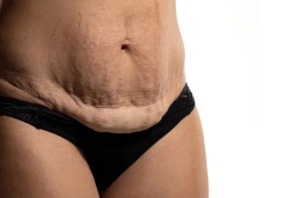 Image of womans stomach after weight loss injections Gerrards Cross showing saggy skin