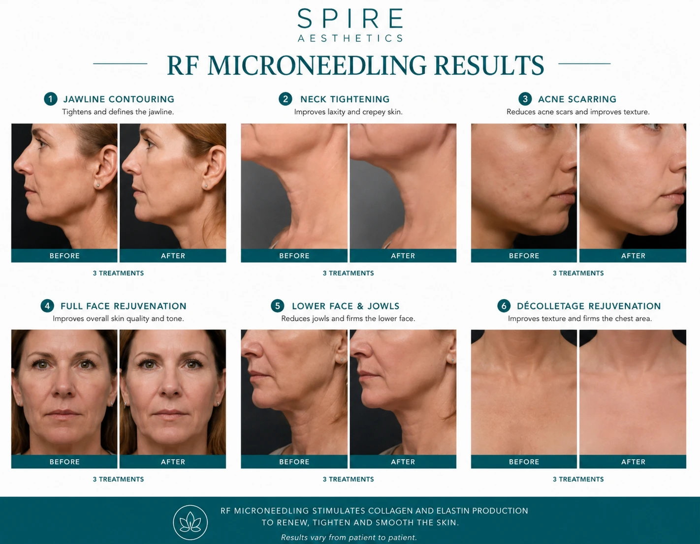 RF Microneedling Skin tightening Gerrards Cross results