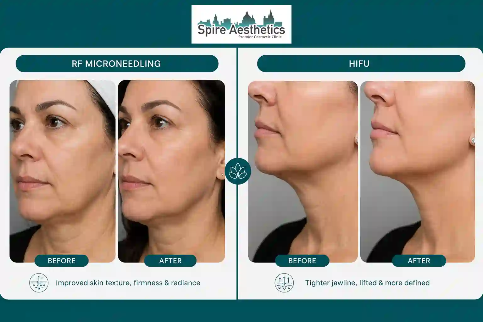 Can RF Microneedling and HIFU Be Combined Gerrards Cross?
