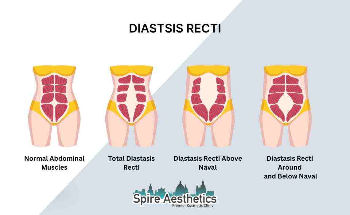 Is Non-Surgical Diastasis Recti Treatment Right for You? Common Concerns Answered Gerrards Cross